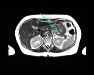 Pancreas MRI — side branch IPMNs
